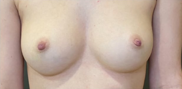 Nipple and Areola Surgery