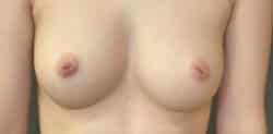 Nipple and Areola Surgery