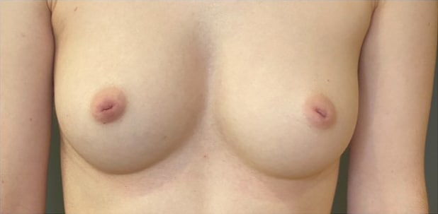 Nipple and Areola Surgery