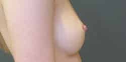 Nipple and Areola Surgery