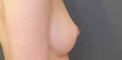 Nipple and Areola Surgery