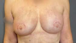 Breast Implant Revision (Explant)