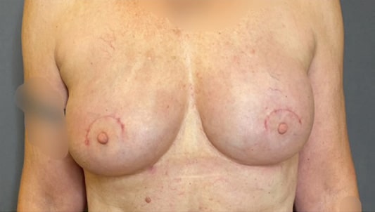 Breast Implant Revision (Explant)