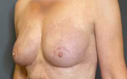 Breast Implant Revision (Explant)