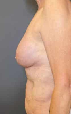 Breast Fat Grafting