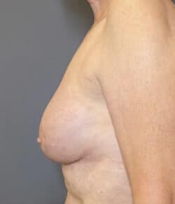 Breast Implant Revision (Explant)