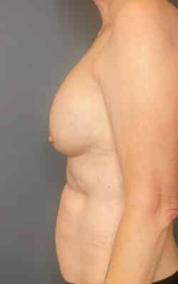 Breast Fat Grafting