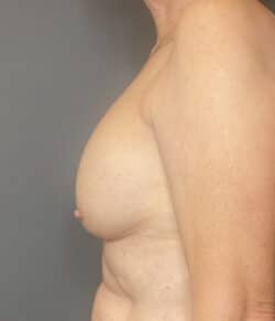 Breast Implant Revision (Explant)