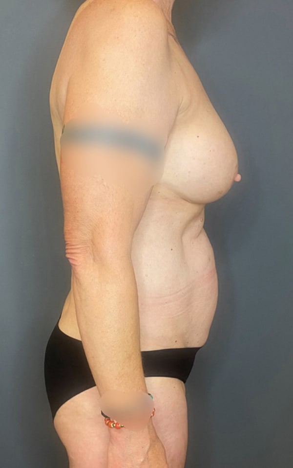 Breast Fat Grafting