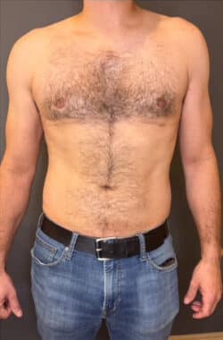 Gynecomastia (male breast reduction)