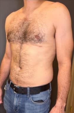 Gynecomastia (male breast reduction)