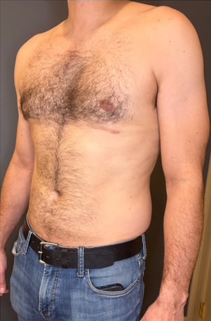 Gynecomastia (male breast reduction)