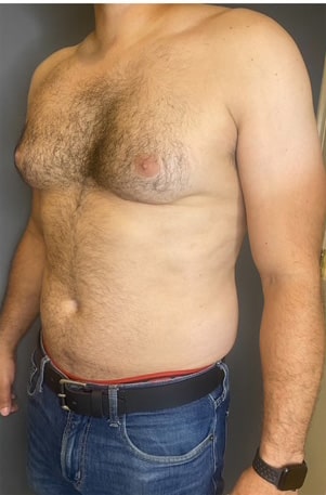 Gynecomastia (male breast reduction)