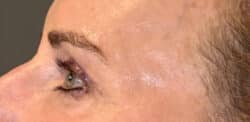 Eyelid Tuck