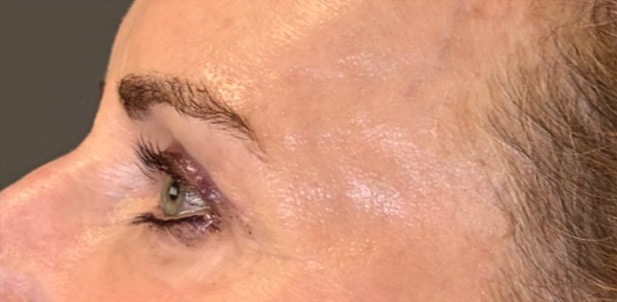 Eyelid Tuck