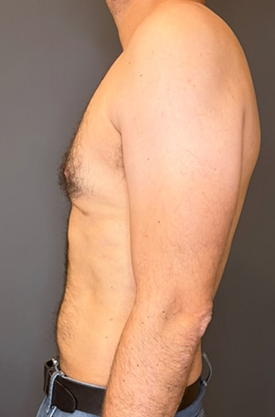 Gynecomastia (male breast reduction)