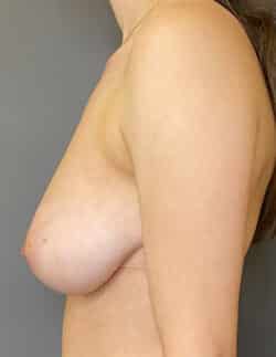 Breast Reduction (female)