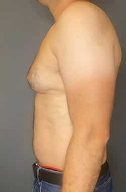 Gynecomastia (male breast reduction)