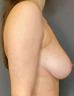 Breast Reduction (female)