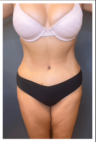 Tummy Tuck