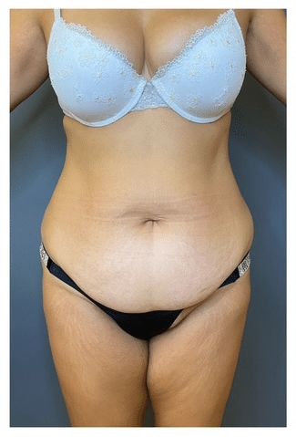 Tummy Tuck