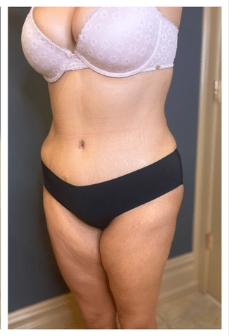 Tummy Tuck