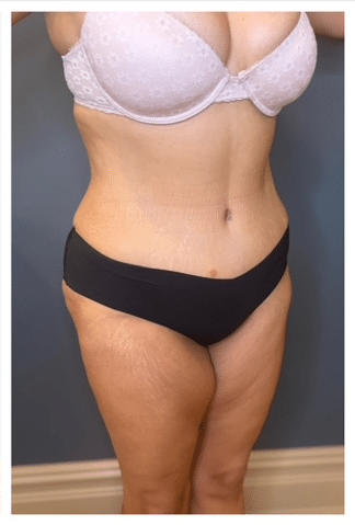 Tummy Tuck