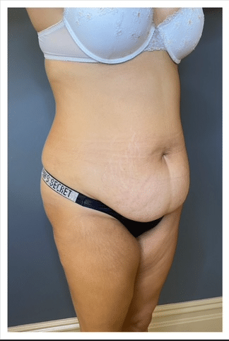 Tummy Tuck