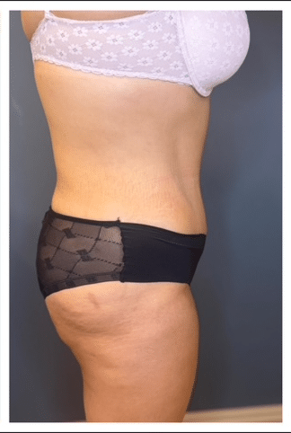 Tummy Tuck