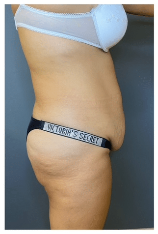 Tummy Tuck