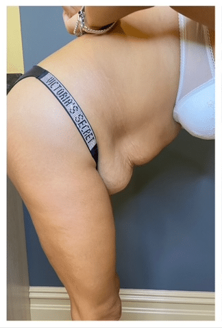 Tummy Tuck