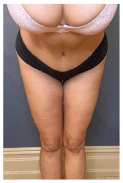 Tummy Tuck