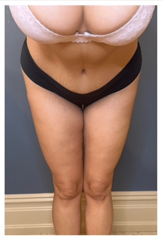 Tummy Tuck