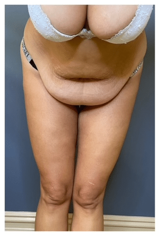 Tummy Tuck