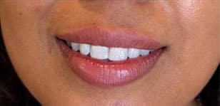 Lip Augmentation