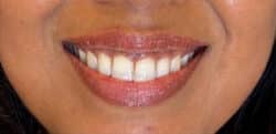 Lip Augmentation