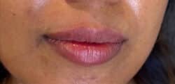 Lip Augmentation