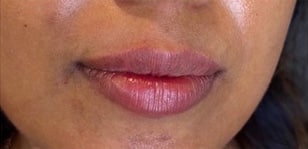 Lip Augmentation