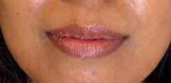 Lip Augmentation