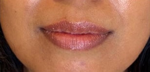 Lip Augmentation
