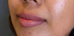 Lip Augmentation
