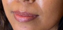 Lip Augmentation