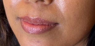 Lip Augmentation